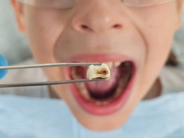 Best Emergency Dentist for Knocked-Out Tooth in Ashland, IL